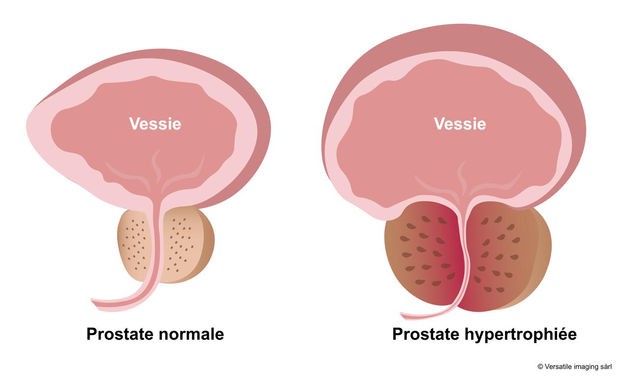 Anatomie de la prostate