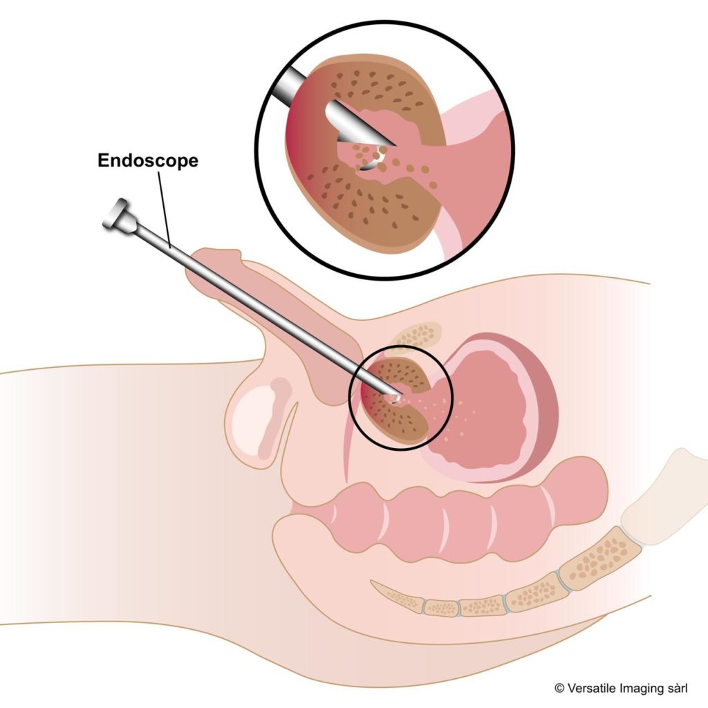 Traitement chirurgical
