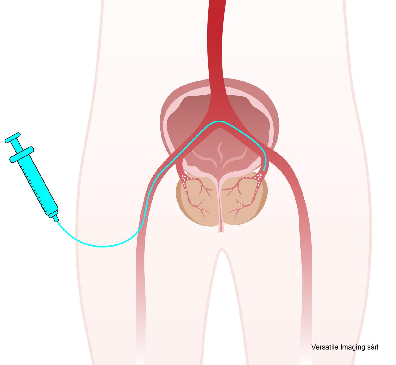 Procédure d'embolisation