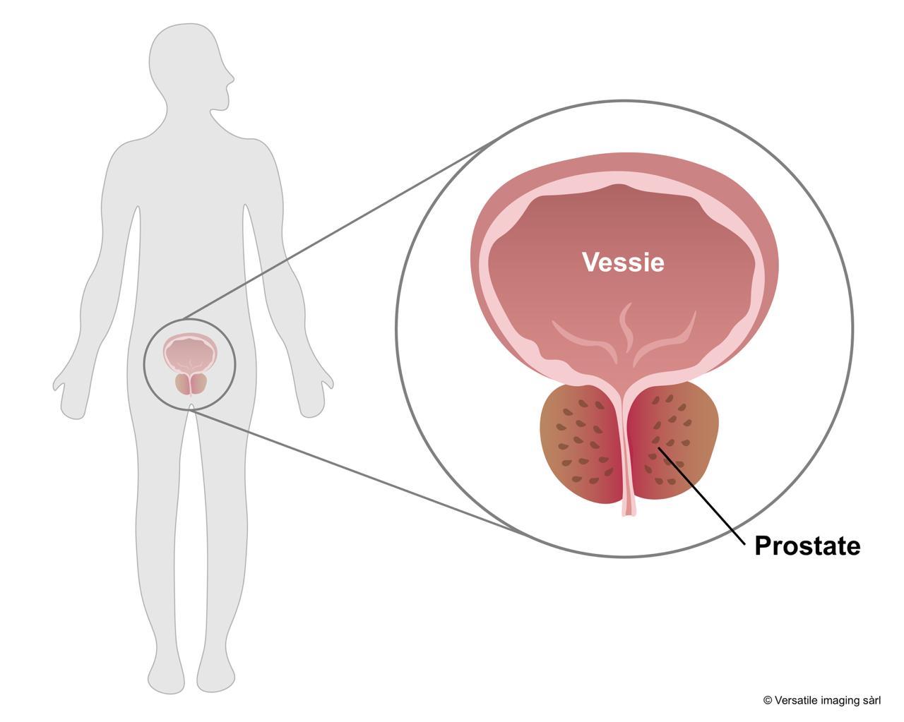 Hypertrophie bénigne de la prostate